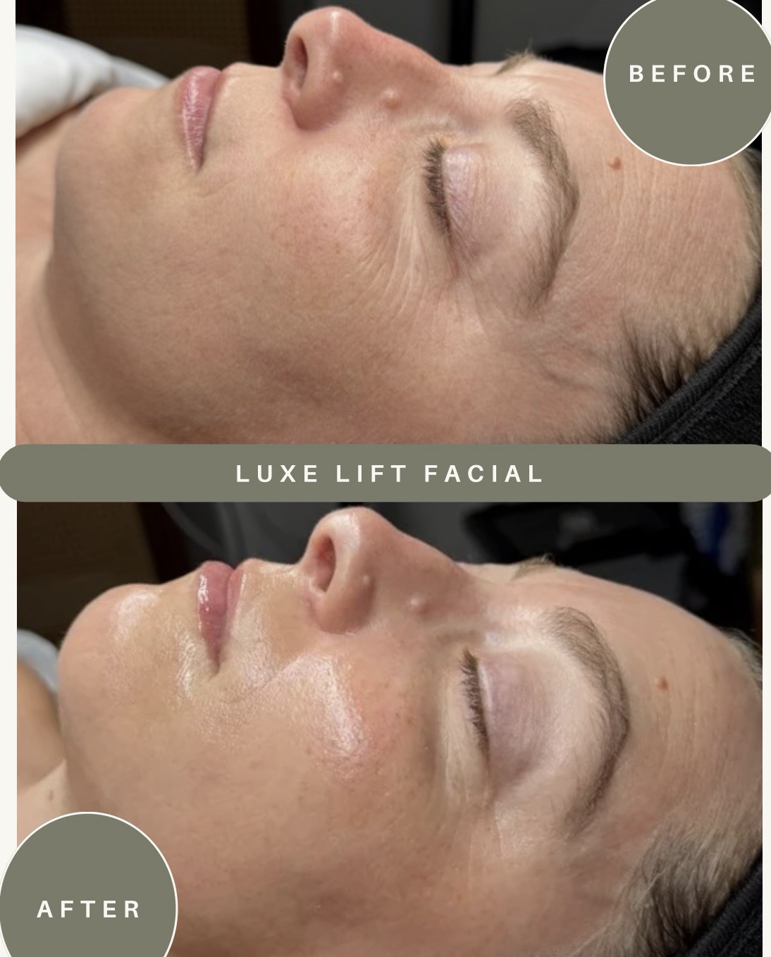 Luxe facial results