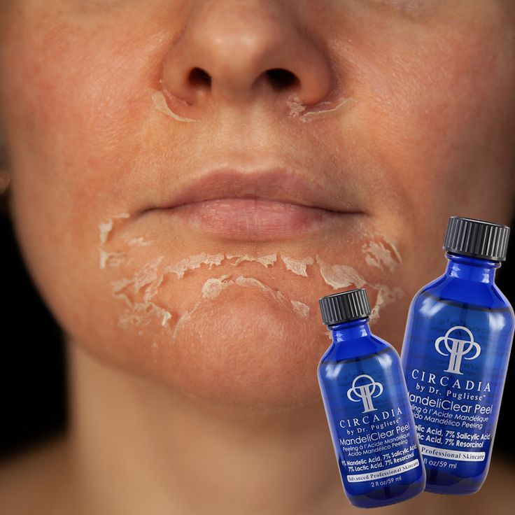 MandeliClear peel treatment